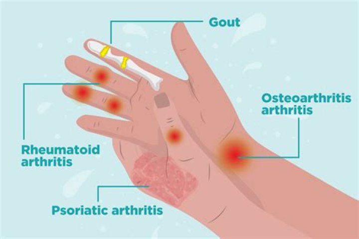 Can golf cause arthritis in hands?