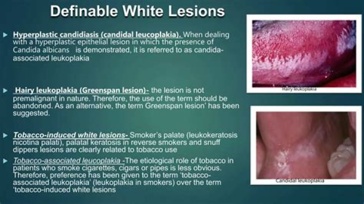 Can you go from OHL to NCAA?