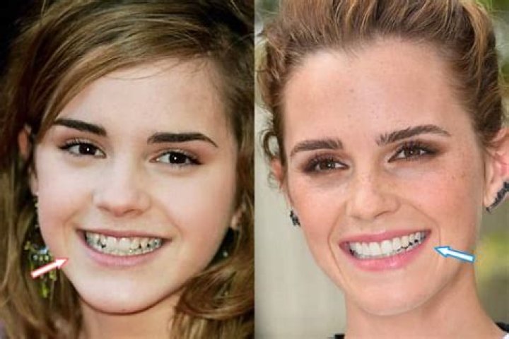 Did Emma Watson have braces?