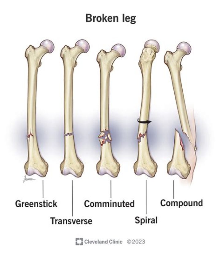 How common are broken bones in skateboarding?