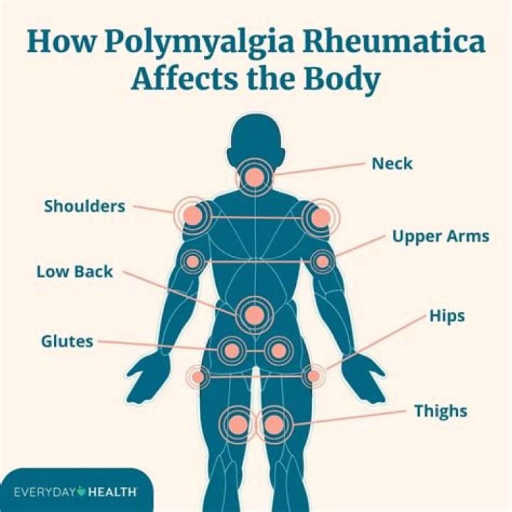 How long can polymyalgia rheumatica last?
