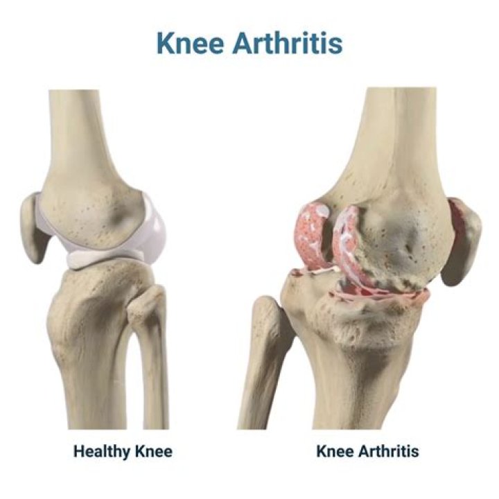 Why do my knees hurt after ice skating?